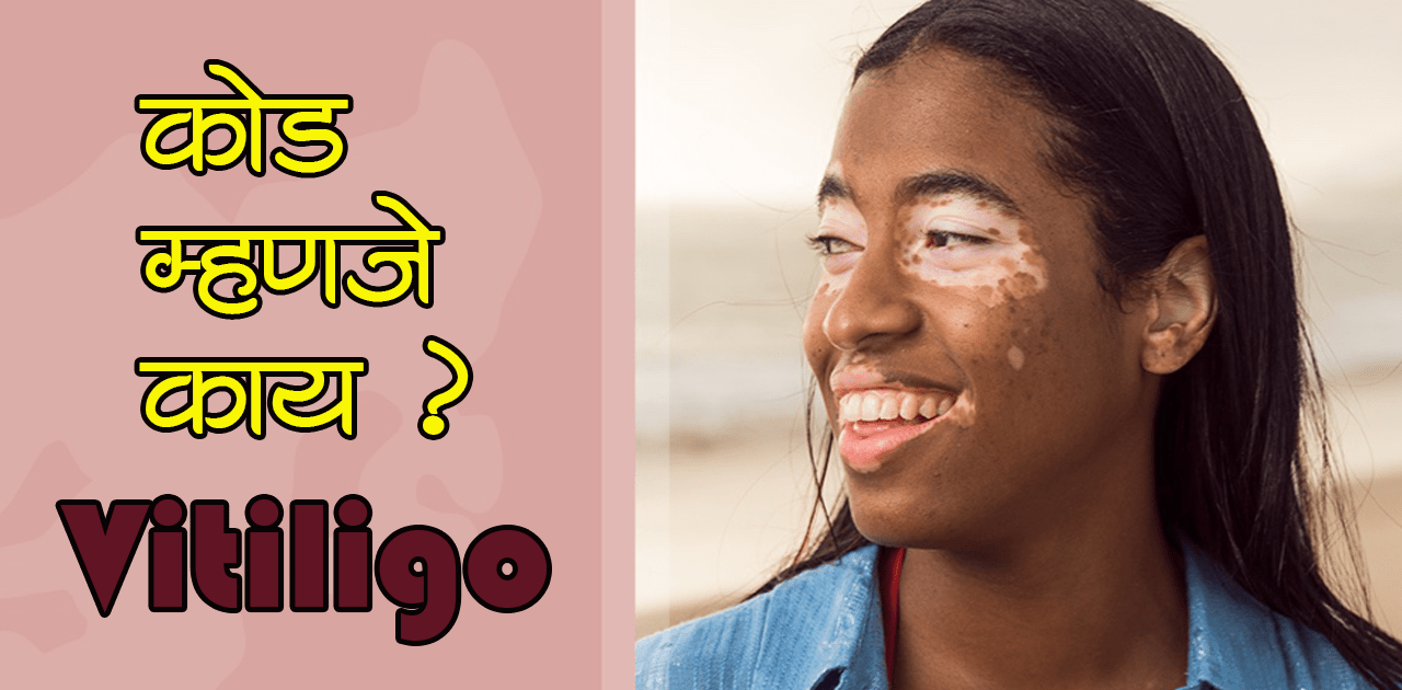  Vitiligo